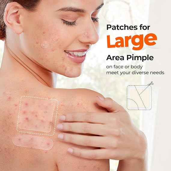 TKTK Large Pimple Patches for Face 120 Count + XL Acne Patches for Body 136 Count, 7 Sizes Pimple Patch Bulk Face & Body, Hydrocolloid Zit Breakouts