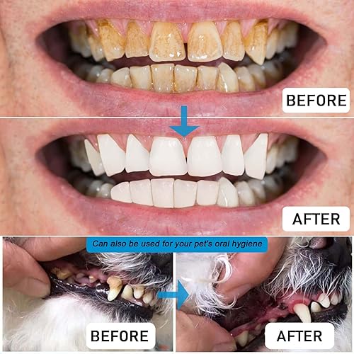 Miniatura 4 de 3 herramientas dentales 100  quirúrgicas de acero inoxidable 304 kit profesional de limpieza de dientes para uso doméstico removedor de placa de