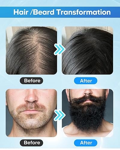 Miniatura 6 de Sello de microneedling Derma ajustable, bolígrafo de microagujas profesional, bolígrafo de rodillo Derma con microagujas, sello de titanio