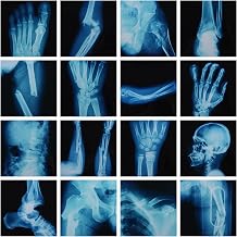 16Pcs Realistic Broken Bones X-Ray 9.8"x9.8" Skeleton X-Rays Human Skeleton Broken Bones PVC Plastic X-Ray Pretend Play Doctor Kit Learning Toy for Role-Playing Homeschooling School Supplies