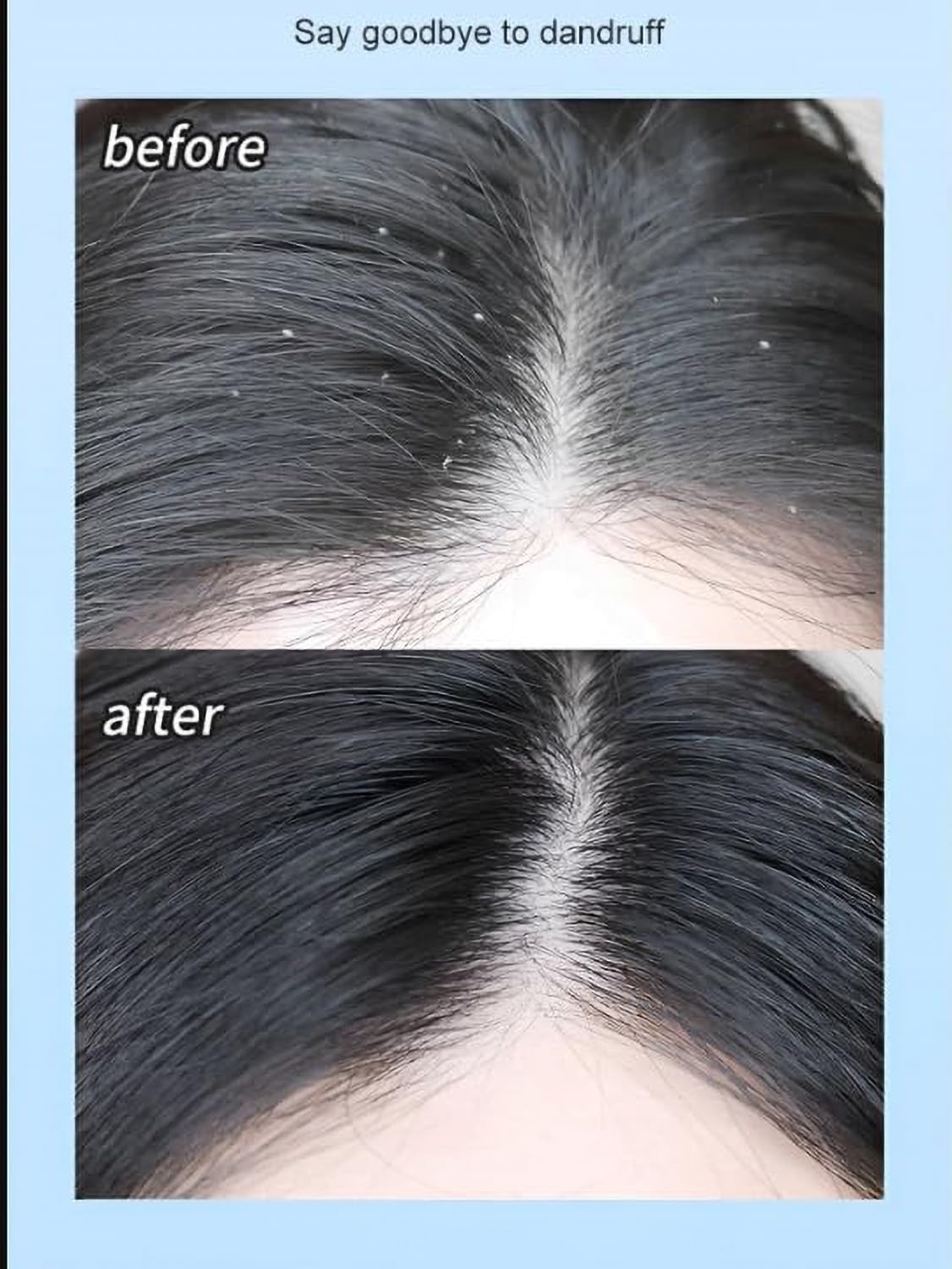 Anti-Dandruff Shampoo, Professional Anti-Dandruff Shampoo, Deep Cleaning Scalp Refreshing Control Oil Nourish Hair For Men Women (Color : 3Count (Pack of 3))