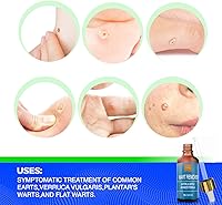 Vista 2 de Liquid Wart Remover - Loción avanzada para tratamiento de verrugas para todo tipo de verrugas, incluyendo comunes y genitales, sin dolor y de acción