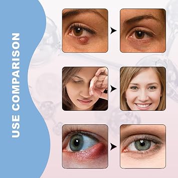 Chalazion & Blepharitis Treatment Eye Cream – Soothing Relief for Swollen Eyelids, Redness & Irritation - Chalazion Treatment for Stye, Puffiness & Dryness - Gentle Eyelid Cream for Daily Eye Care