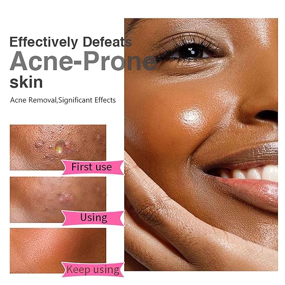 Salicylic Acid Acne Spot Removal Cream, Effectively Defeats Acne-Prone Skin, Refreshing, Oil Control, Prevent Breakouts, Pimples & Blackheads Remove Face Cream 1.76 oz
