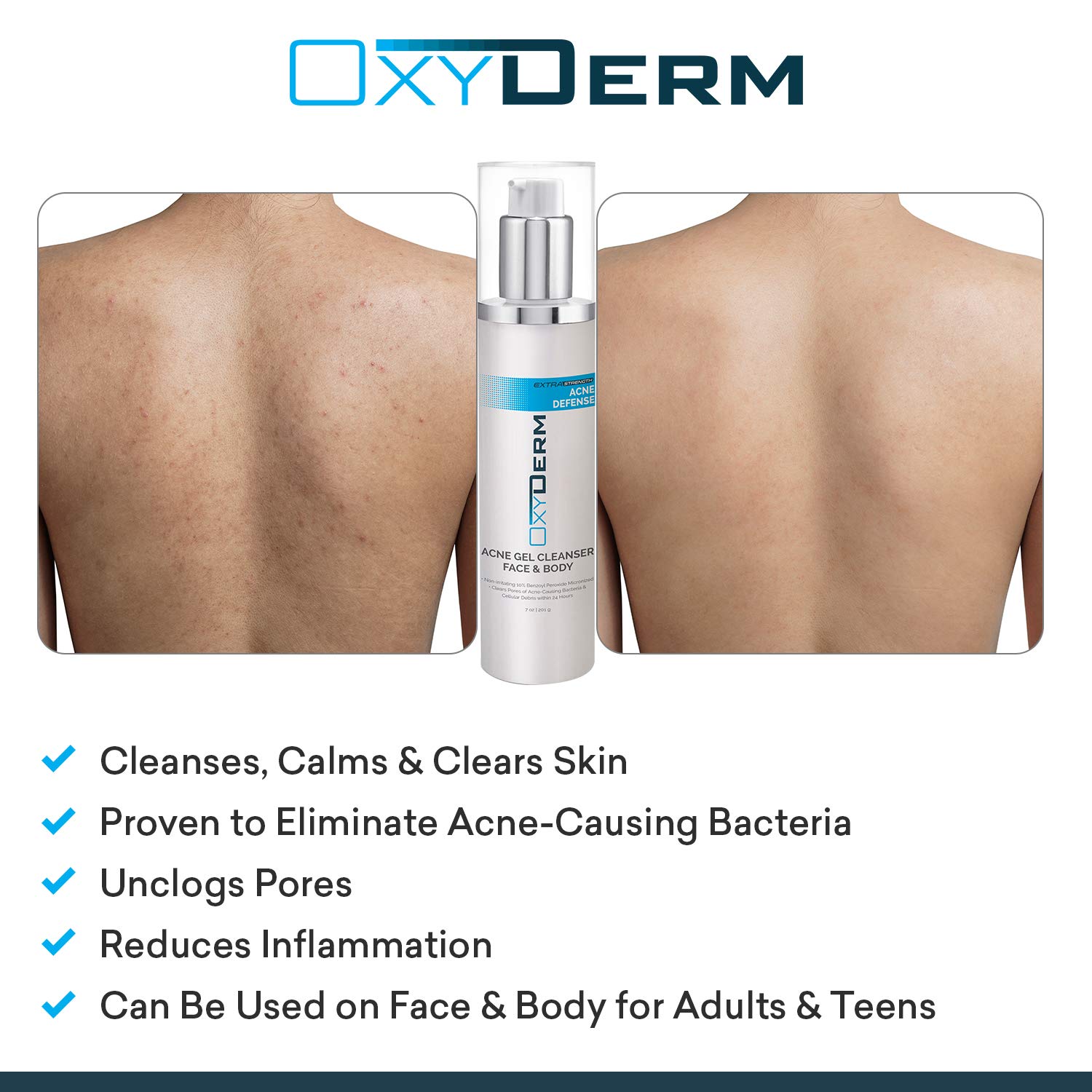 Acne Face wash Treatment with Benzoyl Peroxide 10% - Clears Cystic Breakouts & Fights Acne Blemishes on Contact. Prevents Future Pimples, Blackheads, Whiteheads, Zits, Bumps. For Face & Body.