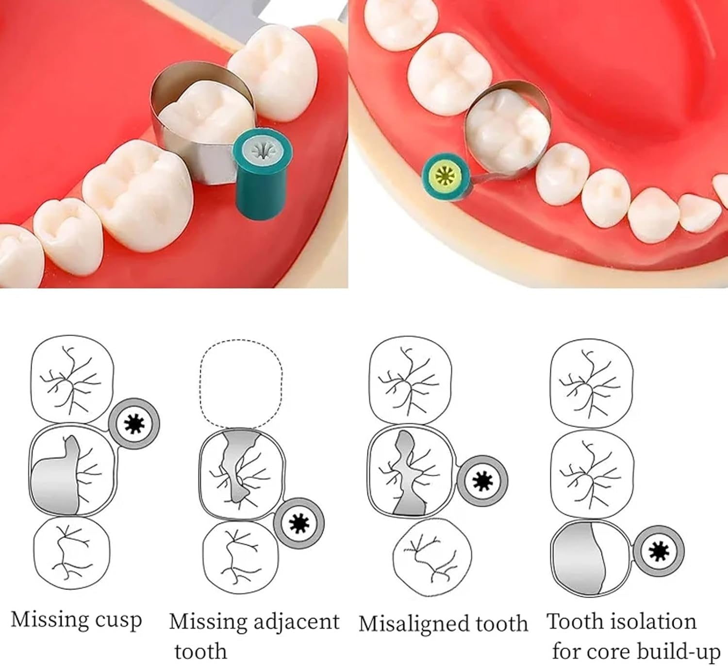 Dental Sectional Matrix System, Adjustable Dental Matrices Matrix Bands, Double-Side Contoured Anatomically Shaped Matrix Bands (SuperLock tensioning Instrument Set)