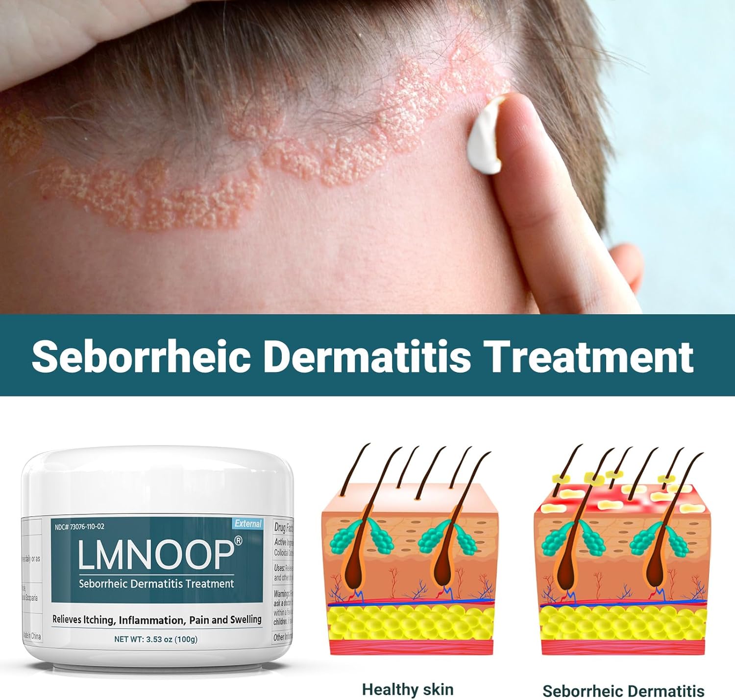 Seborrheic Dermatitis Cream, Extra Strength Scalp Treatment for Psoriasis, Folliculitis, Eczema, Dry Scalp, Dandruff, Anti-Itch and Soothing Skin 3.53 OZ - Image 2