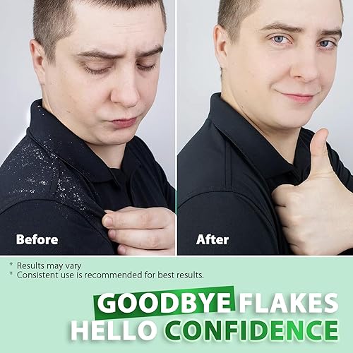 Miniatura 6 de Champú antifúngico para foliculitis y dermatitis seborreica tratamiento de la psoriasis del cuero cabelludo, alivio de la caspa y la picazón del