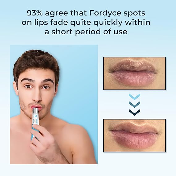 Belani Fordyce Cream - Lip Acne Cream, Fordyce Seeds, Fordyce Cream, Moisturizes, Improves Dry, Belani Lip Mask, Chapped Lips, Reduces Dark Lips - 20ml (Set 2)