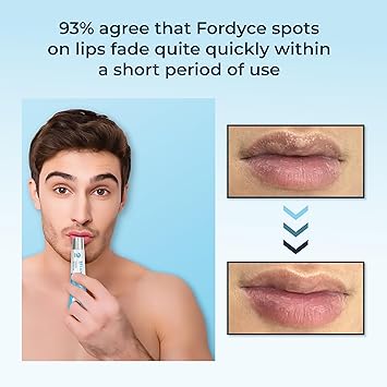 Belani Fordyce Cream - Lip Acne Cream, Fordyce Seeds, Fordyce Cream, Moisturizes, Improves Dry, Belani Lip Mask, Chapped Lips, Reduces Dark Lips - 20ml (Set 2)