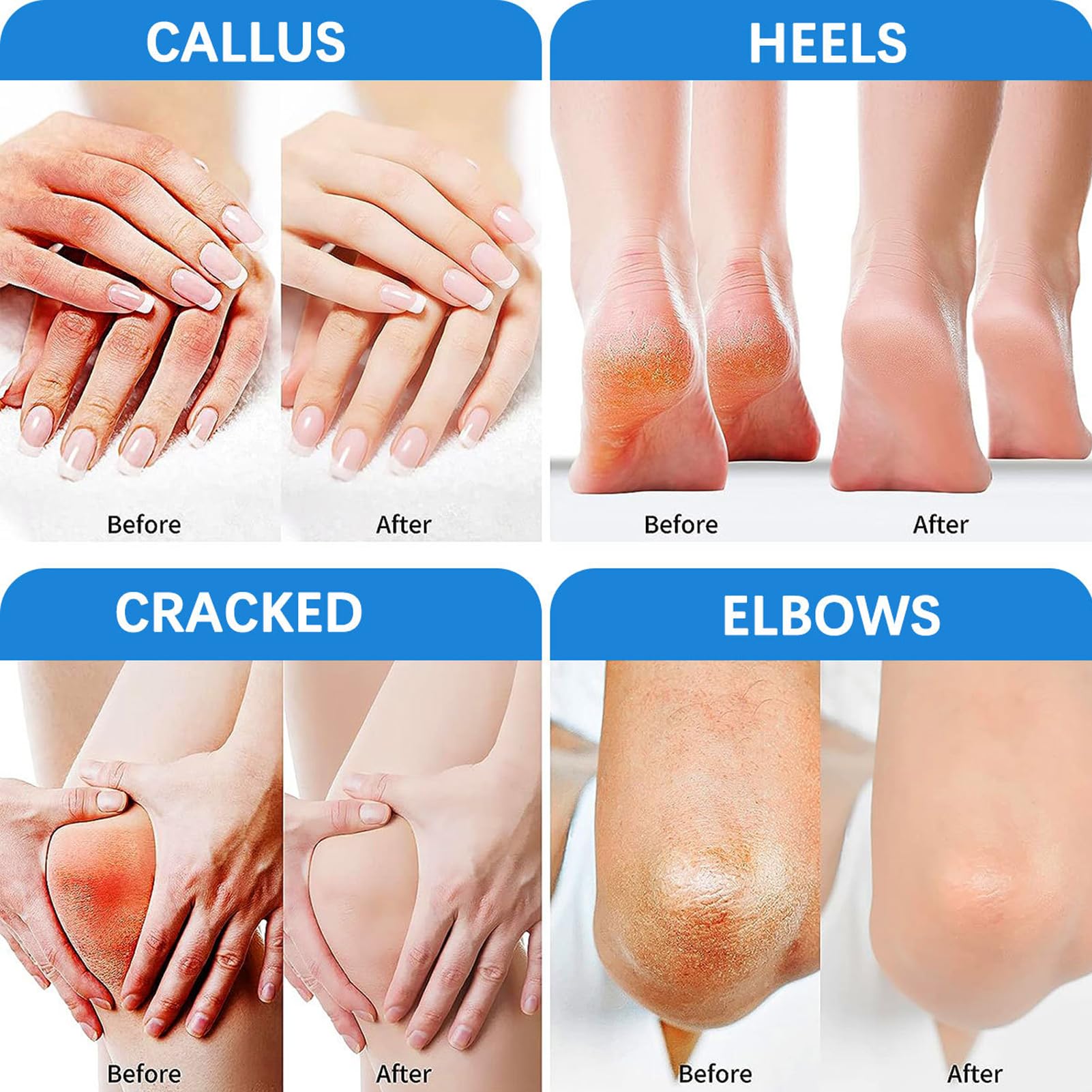 Urea Cream 60 Percent for Feet,Urea Foot Cream for Cracked Heels and Dry Skin - Image 2