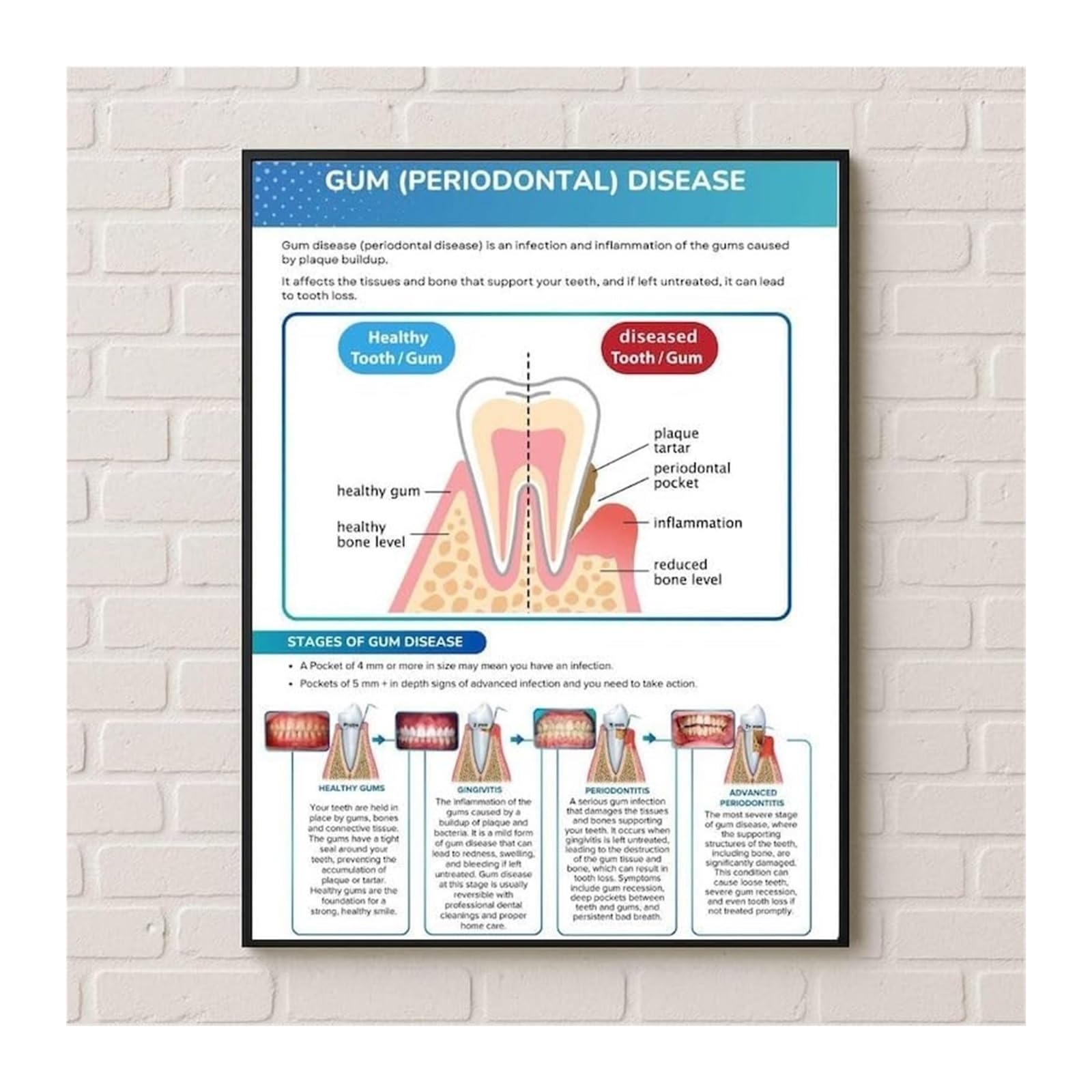 IDGTTLDF Hygiene Education Poster Visual Guide to Plaque Control and Tartar Prevention for Healthy Gums Patient Education Wall Chart Unframed,08x12inch(20x30cm)