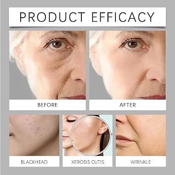 Spot Remover For Face Serum,Dark Spot Corrector Cream,Sun Spots and Melasma Freckle Remover,Spot Remover For Face Serum,Sun Spots and Melasma Treatment Cream for Face 50G