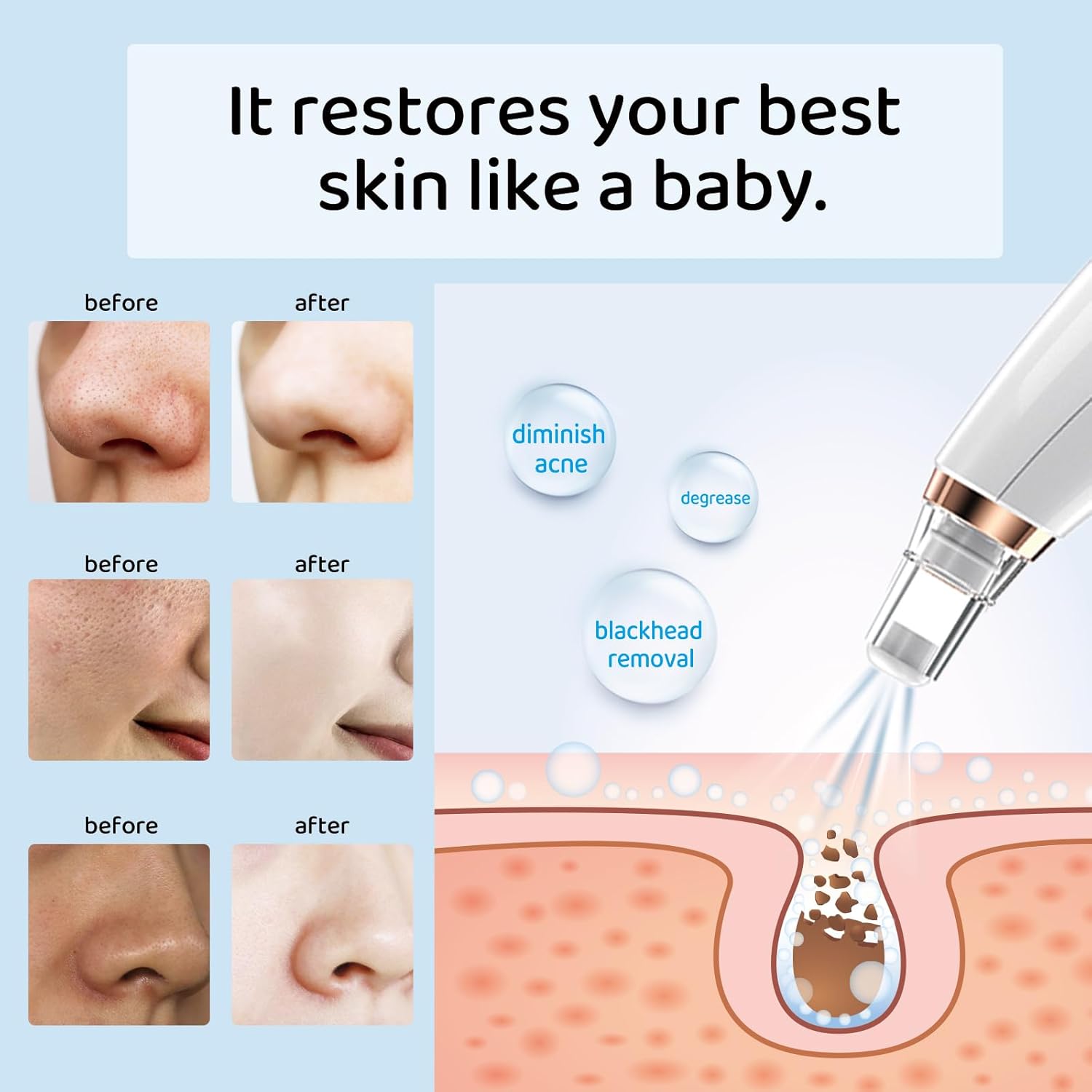 JMSilkAuro: Aspirateur Points Noirs Professionnel - 6 Sondes, 3 Modes, Rechargeable - Image détaillée