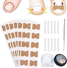 Correcting Stickers, Ingrown Toenail Tool Set, Nail Correction Sticker, Ingrown Toenail Correction, Ingrown Toenail Corrector, Nail Correction Patch, For Nail Care