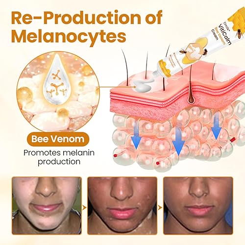 Miniatura 5 de Timilk VitiCalm - Crema de veneno de abeja, crema de vitíligo profesional, tratamiento natural de vitíligo, reduce las manchas blancas y mejora la