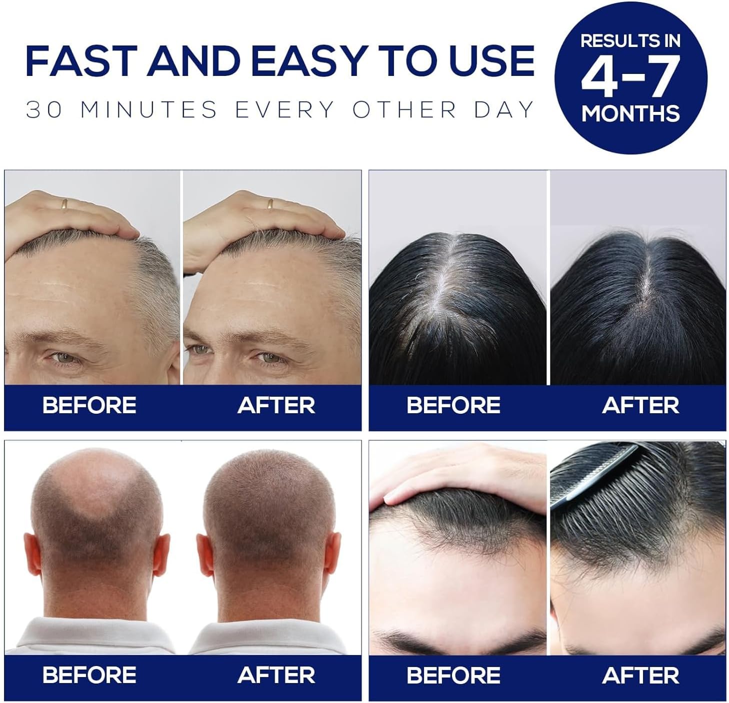 Laser Hair Growth Cap is a Dome-Shaped Low Level Laser Therapy (LLLT) Device Designed to Promote Hair Growth in Women and Men.M1