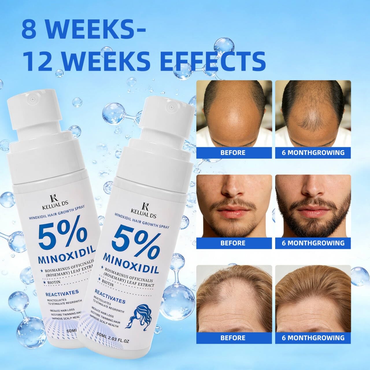 5% Minoxidil Spray-Minoxidil Hair Growth with Biotin & Rosemary for Men and Women,Promote Faster,Stronger,Stop Hair Loss and Thinning Hair,Upgraded Formula-2 * 60ML/4.06FL.OZ