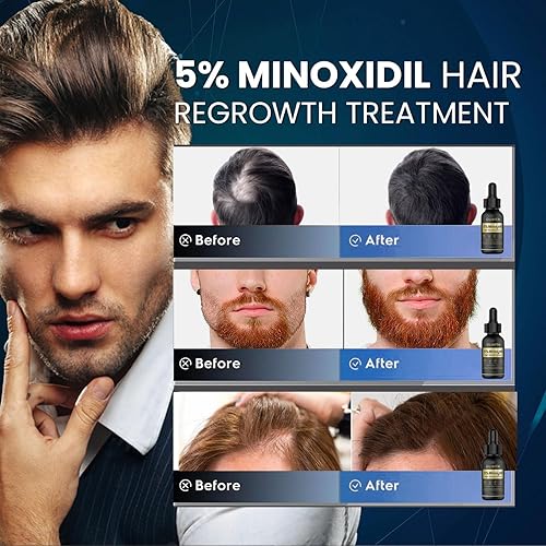 Miniatura 2 de Crecimiento del cabello de minoxidil al 5% para hombres y mujeres suero de biotina para el crecimiento del cabello para la pérdida de barba y