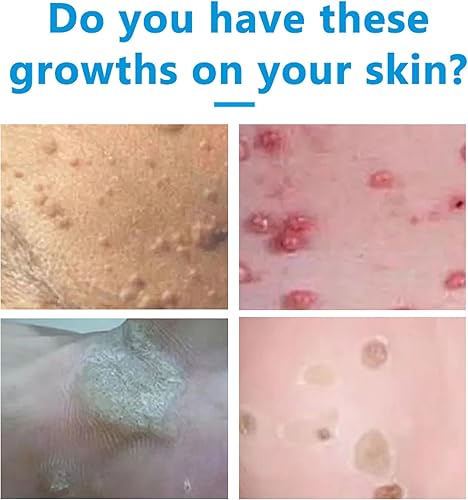 Miniatura 3 de Removedor de verrugas 0.71 oz, crema para eliminar verrugas genitales, removedor de verrugas, adecuado para hombres y mujeres, suave y no irritante,