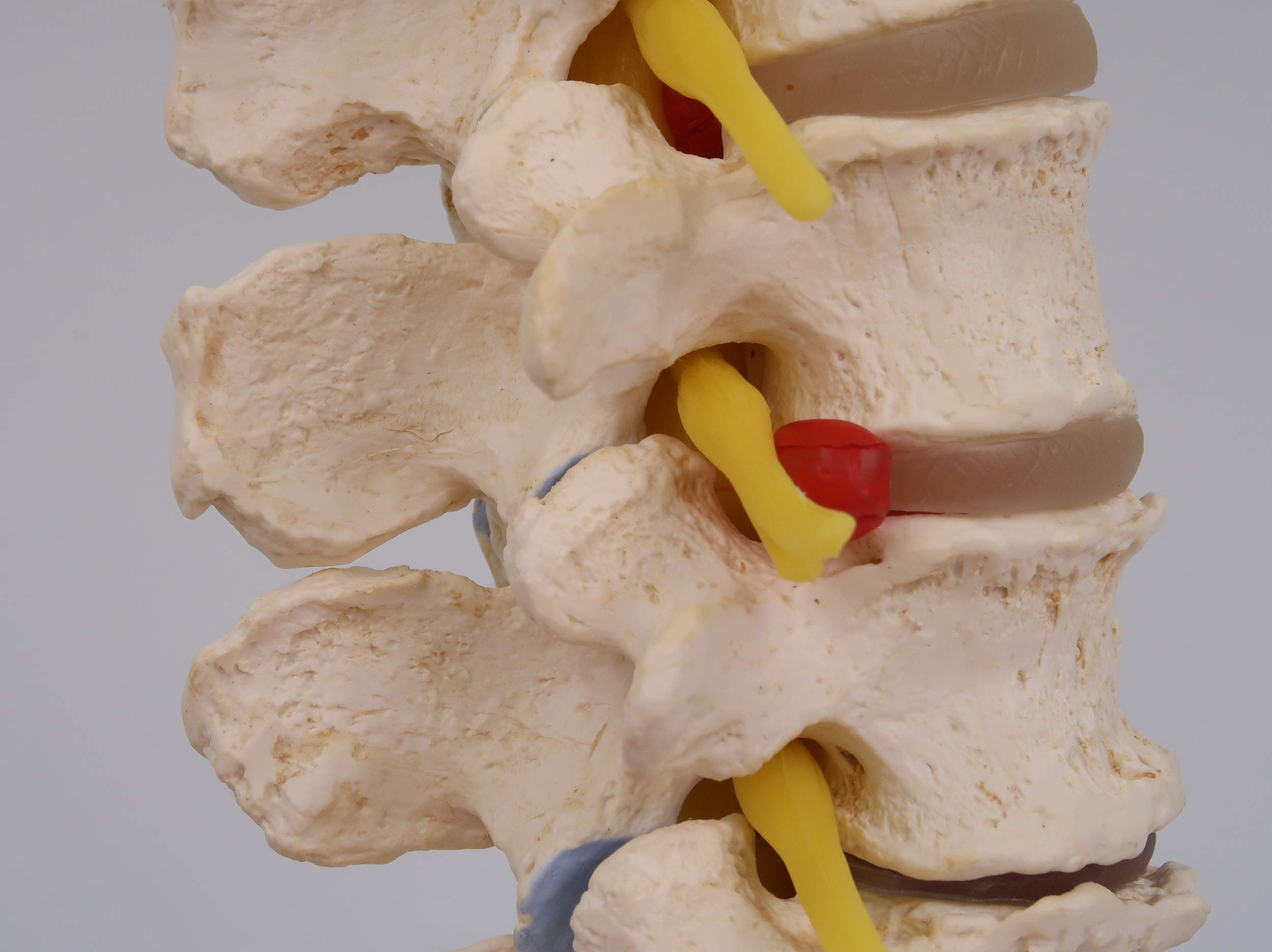3B Scientific A795 Stadi dell'Ernia del Disco Intervertebrale e Degenerazione della Vertebra + software gratuito di anatomia - 3B Smart Anatomy