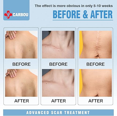 Miniatura 6 de Carbou Hojas de silicona médica para cicatrices (rollo de 1.6 x 120 pulgadas), cinta de silicona suave para cicatrices, cinta de silicona fácil de
