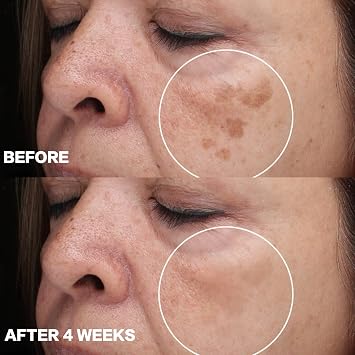 Dark Spot Remover for Face and Body: Dark Spot Corrector Cream - Enriching Skin Care for All Skin Tones - Ideal for Sun Spots, Melasma, Freckles, and Blemish Reduction 1 fl oz
