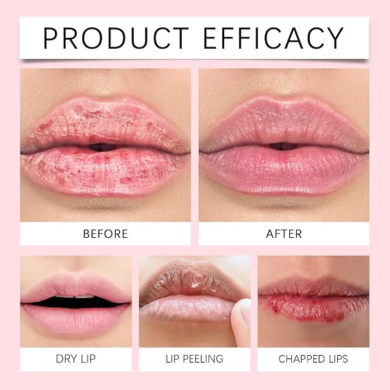 Fordyce Spot Remover Lip Balm for Dry Lips,Lip Repair&Brightening for Dark Lips,Gentle Hydrating Lip Cream to Remove Dead Skin&Fade Fine Lines,Long-Lasting Nourishment for Girls&Women,Effective Care