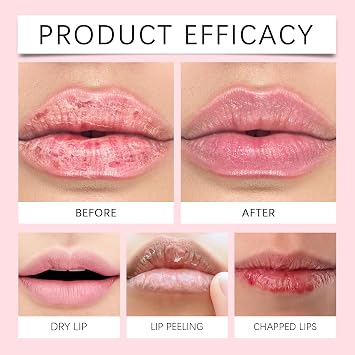 Fordyce Spot Remover Lip Balm for Dry Lips,Lip Repair&Brightening for Dark Lips,Gentle Hydrating Lip Cream to Remove Dead Skin&Fade Fine Lines,Long-Lasting Nourishment for Girls&Women,Effective Care