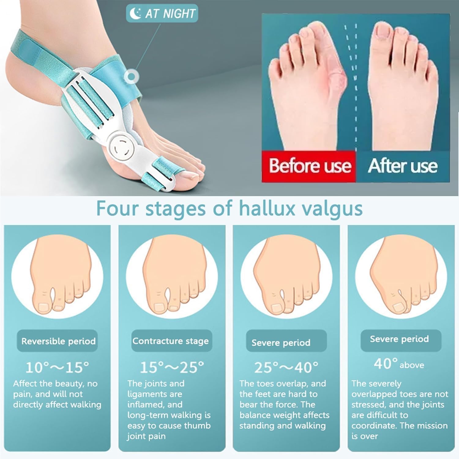 Xeerabdi Bunion Corrector for Men & Women | Orthopedic Toe Straightener with Adjustable Knob | Medical Grade Splint for Pain Relief and Foot Alignment | Fits Both Feet 4