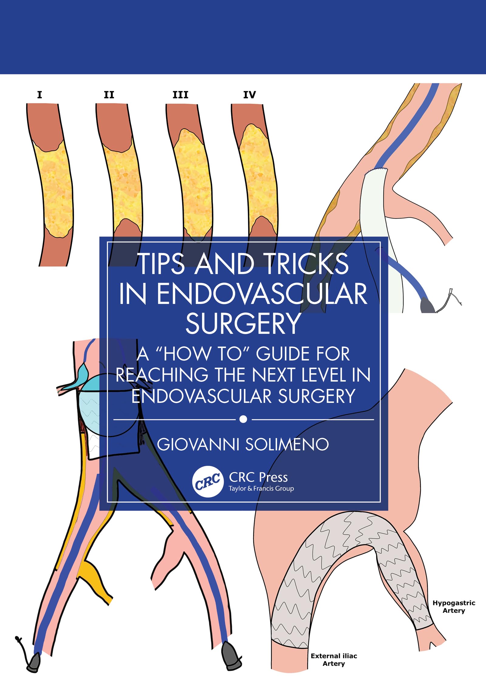Tips and Tricks in Endovascular Surgery: A "How to" Guide for reaching the next Level in Endovascular Surgery (English Edition)