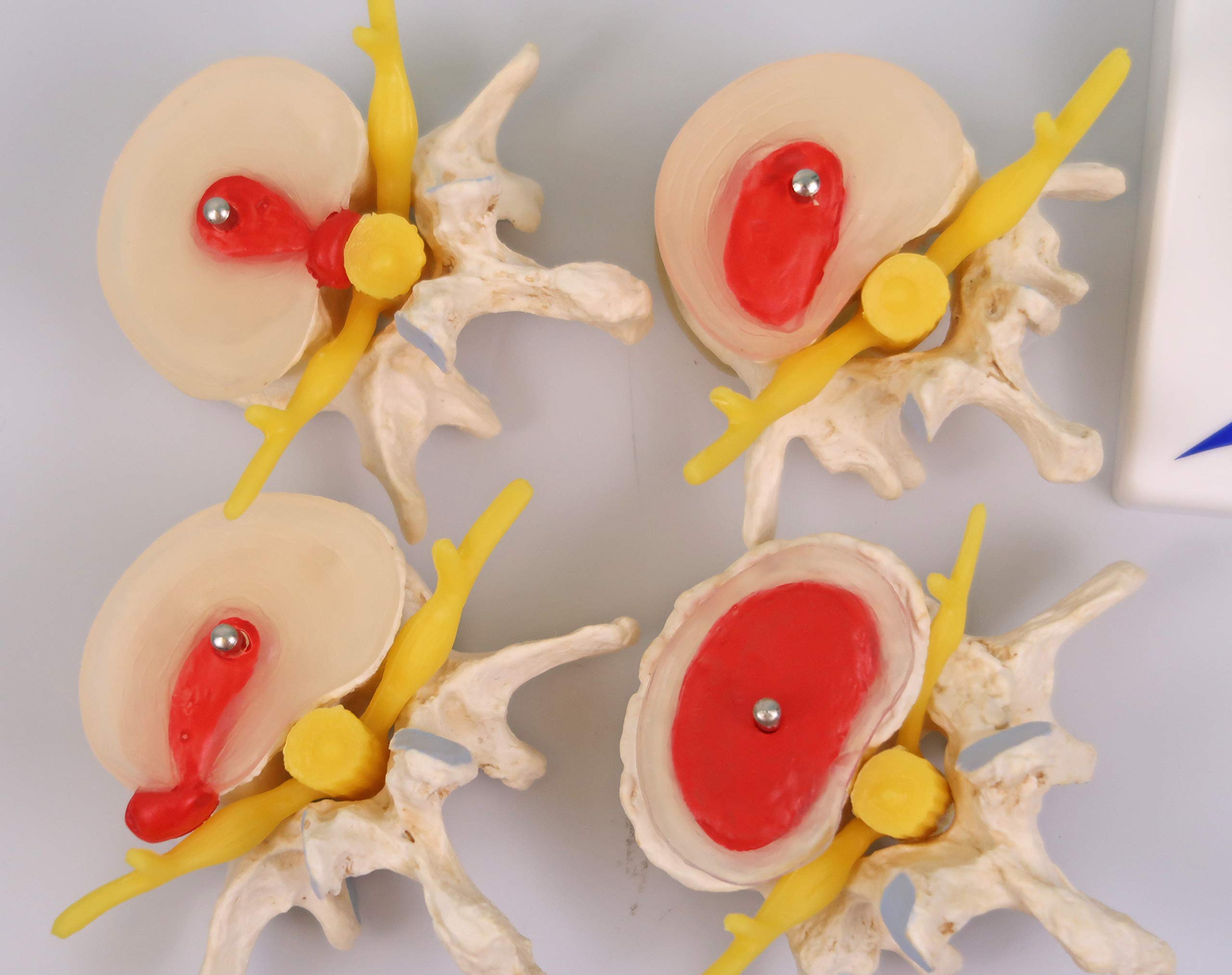 3B Scientific A795 Stadi dell'Ernia del Disco Intervertebrale e Degenerazione della Vertebra + software gratuito di anatomia - 3B Smart Anatomy