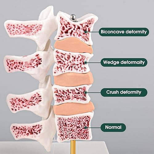 Miniatura 3 de Ultrassist Modelo de anatomía humana de osteoporosis - Modelo seccional de esqueleto de vértebras con tarjeta de estudio para demostración de