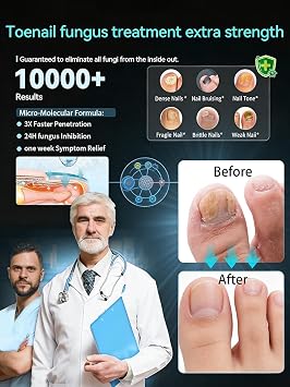 2026 Upgrade Toenail Fungus TreatmentMaximum Undecylenic Acid & Tea Tree