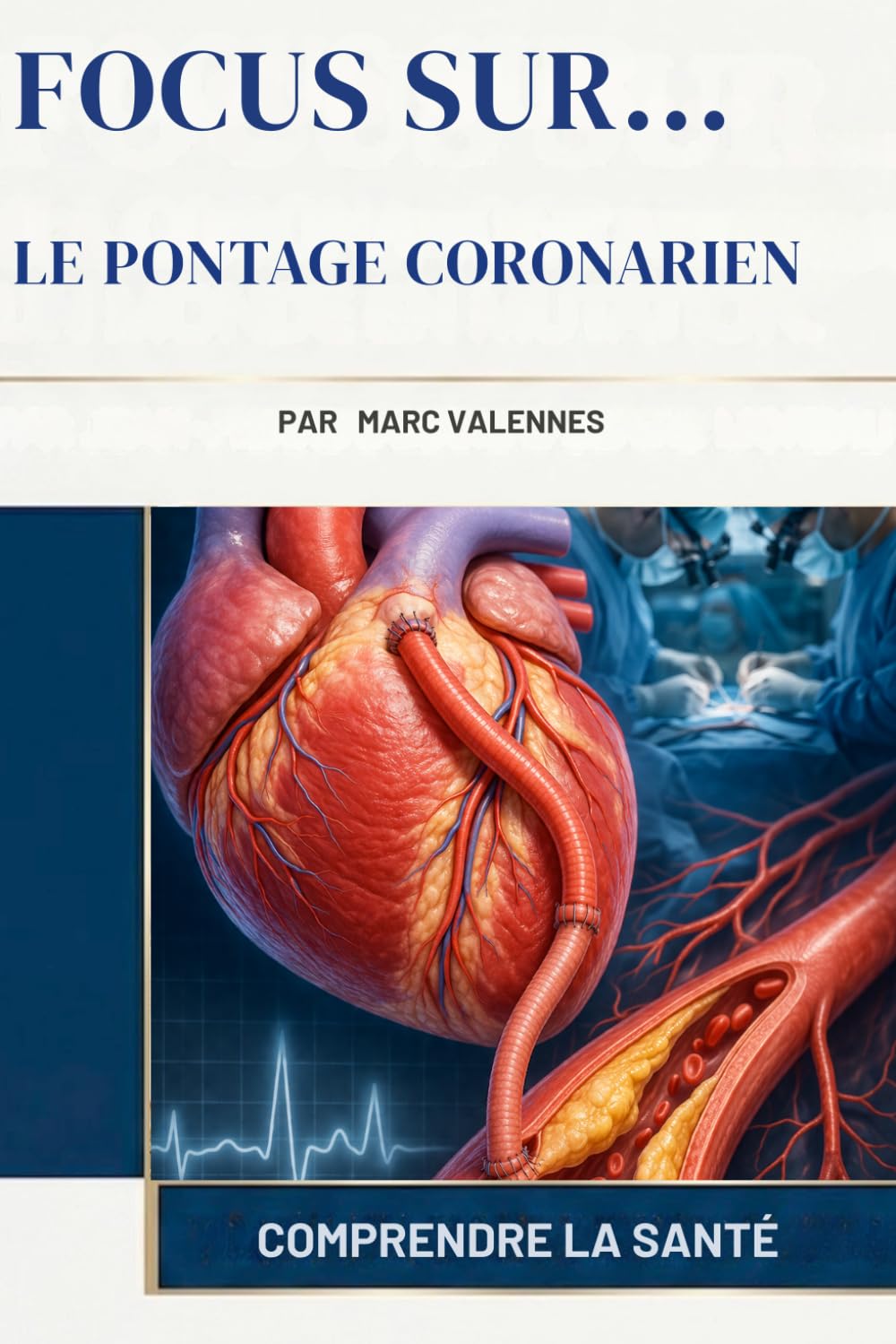 Le Pontage Coronarien (Focus Sur...)