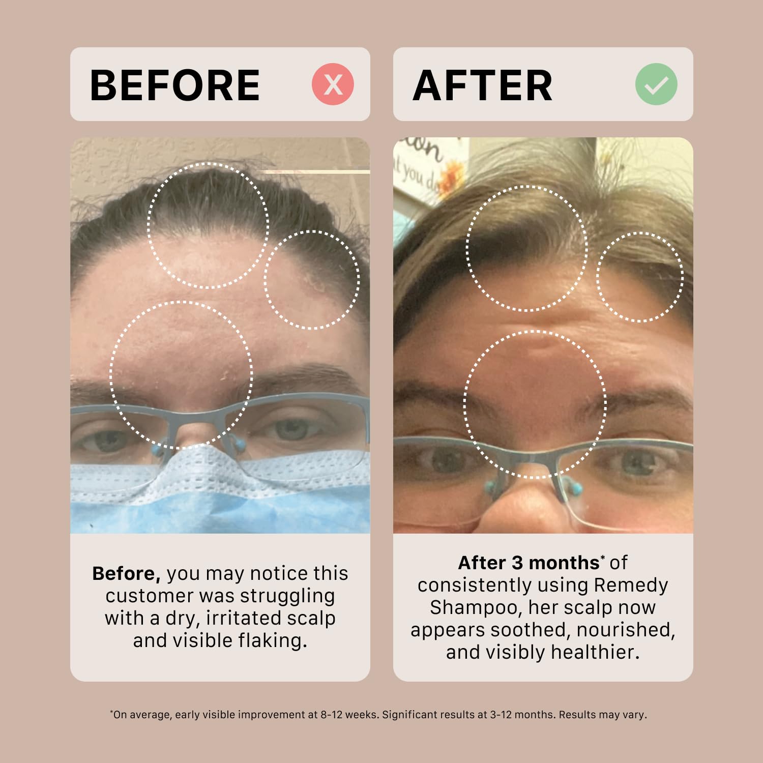 ACTIIV Ultimate Scalp Trio | Soothes Dry, Itchy Scalp, Reduces Flakes, Strengthens And Hydrates Hair, Includes Dandruff Shampoo, Conditioner & Scalp Massager, Vegan, For All Hair Types - Image 5