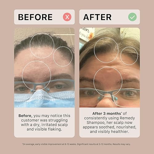 Miniatura 5 de ACTIIV Ultimate Scalp Trio  Alivia el cuero cabelludo seco y con picazón, reduce las escamas, fortalece e hidrata el cabello, incluye champú para la