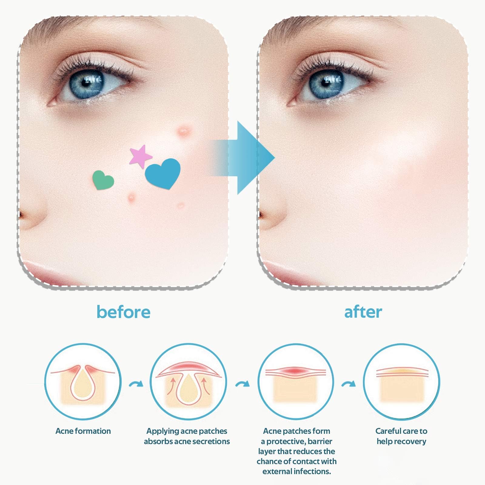 504 Pcs Acne Pimple Patch, 7 Colors Dots Star Pimple Patches, Acne Pimple Patches for Face Cute Zit Patches Pimple Stickers Acne Dots - Image 3