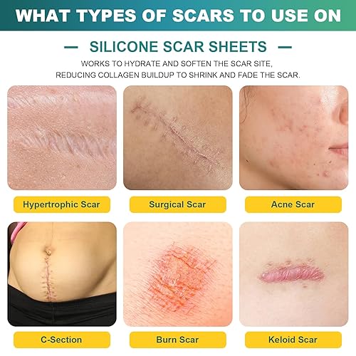 Miniatura 2 de Cinta de silicona para cicatrices, hojas de silicona para cicatrices (rollo de 1.6 x 59 pulgadas, rollo de 4.9 ft), láminas de silicona para