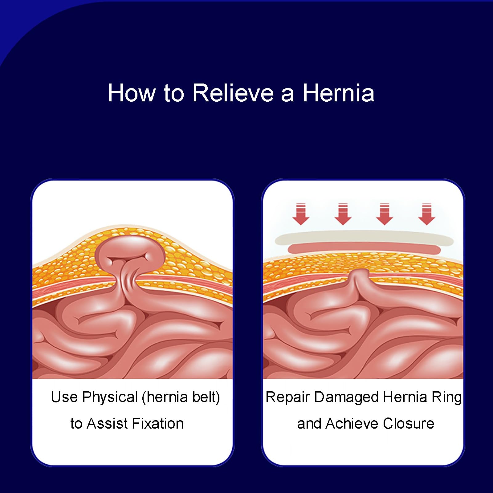 Fascia Ernia Ombelicale, Fascia Elastica Addominale con Cuscinetto di Compressione Rimovibile, Supporto per Ernia Recupero Pre-Post-Operatorio e Prevenzione