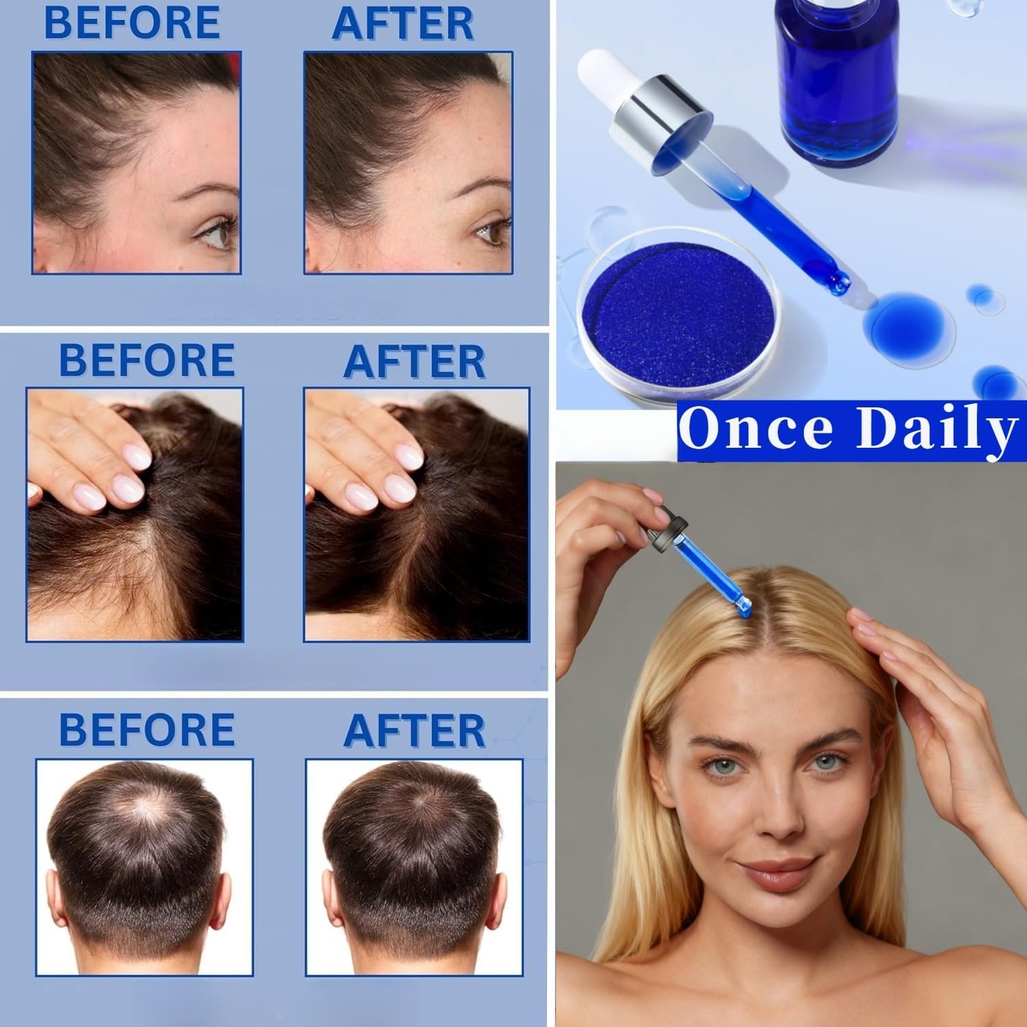 ahk-cu peptide hair growth evidence Amazon.com : 99% AHK-Cu Copper Peptide 1 Gram CAS 49557757 Purity 99+ for Scalp Health Hair Scalp Care Fast Absorption Water Soluble Soft Shiny Hair : Beauty & Personal Care