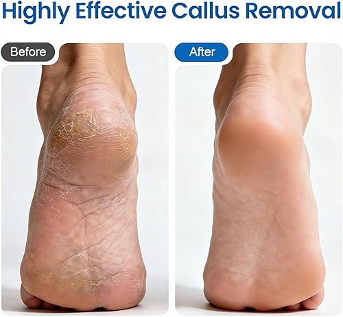 Miniatura 4 de Removedor eléctrico de callos para pies, 60 discos de papel de lija de repuesto, ajuste de velocidad de 1200 RPM, cuerpo de metal, eliminación de