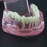 Vista 5 de Modelo de dientes dentales modelo de implante Typodont enseña estudio demostración análisis de dientes, demostración de restauración de dientes 2001