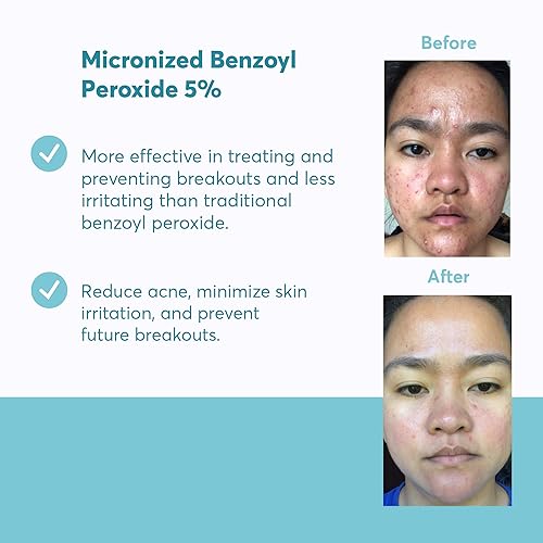 Miniatura 3 de MDacne - Crema Tratamiento para Acné BPO 5 05 Oz