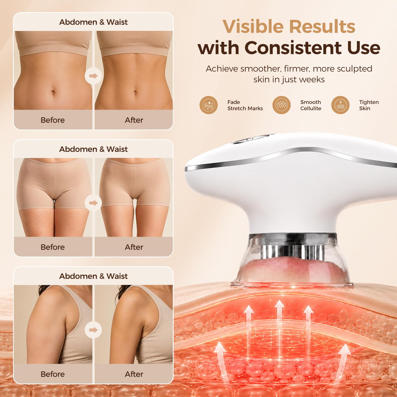 4 in 1 Body Sculpting Machine, Anti Cellulite Massage Tool,Lymphatic Drainage Massager,Reduce Stretch Marks & Cellulite & Tightens Skin,for Back, Belly, Arms, Legs.(White)