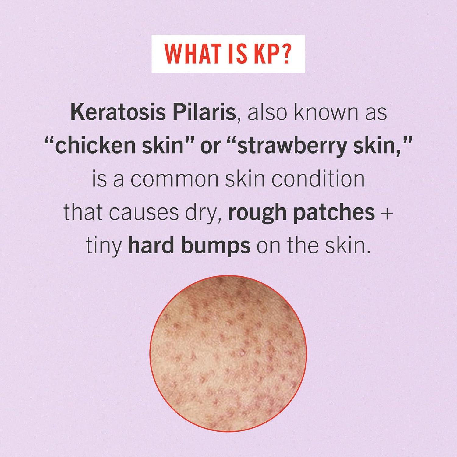 First Aid Beauty - Exfoliating Bundle: KP Bump Eraser Scrub & Ingrown Hair Pads with 10% BHA and AHA, Daily Exfoliating Skin Treatment, Keratosis Pilaris Cleanser, Reduce Bumps, 8oz, 28 Pads, 2ct