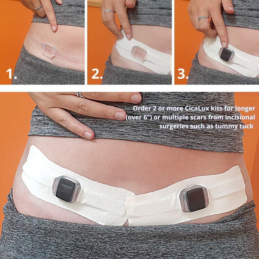 CicaLux Scar Treatment for Surgical Scars - Triple Action Heat, Pressure & Hydration Treatment for Old & New Scars - Silicone Scar Tape for Tummy Tuck - C Section Recovery Must Haves - 60 Day Supply