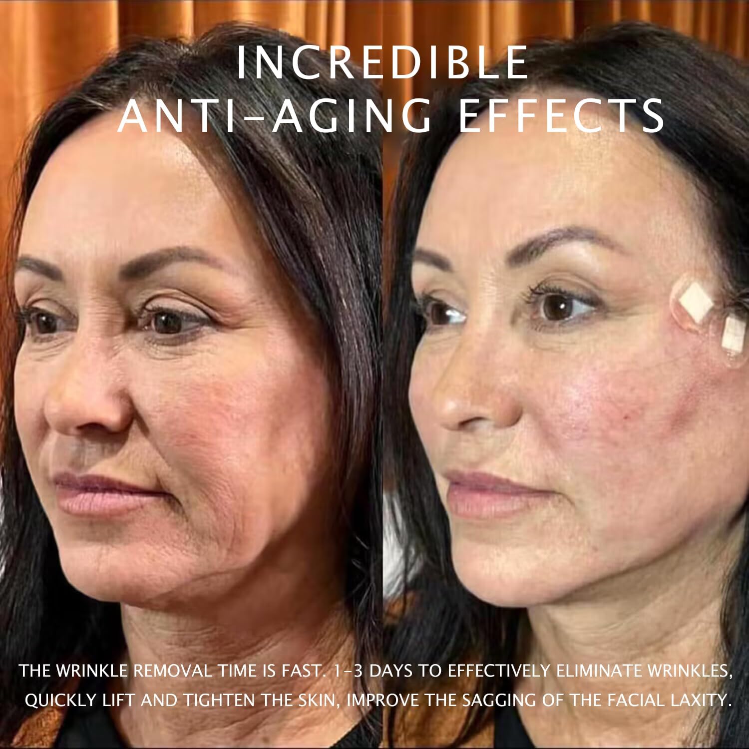 Hilos PDO para Elevación Facial 18G100mm, Hilo de Espina de Pescado, 20 Unidades de Hilos de Engranaje, Producción de Colágeno, Tratamiento Antienvejecimiento, Reducción de Arrugas