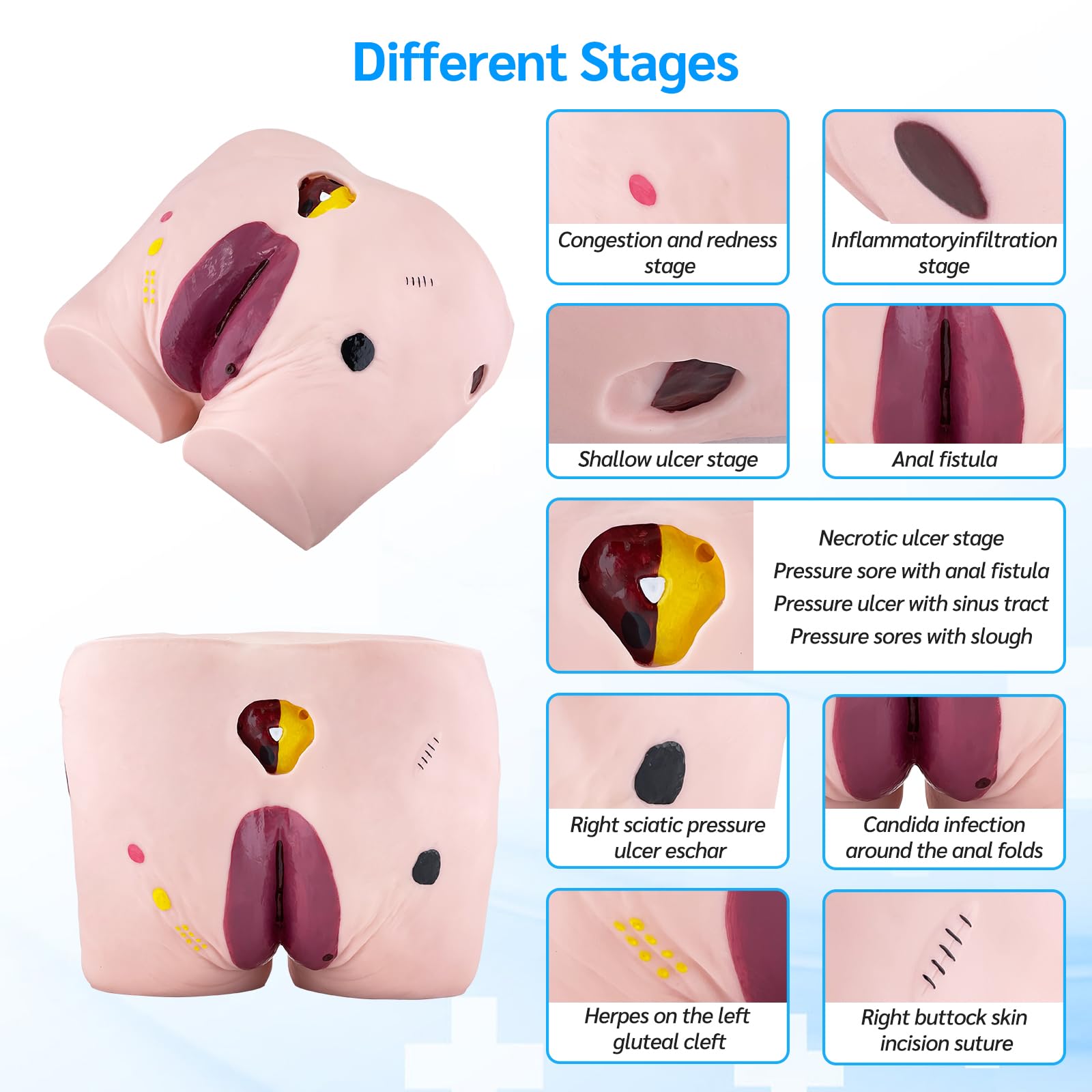 Modèle d'Ulcère de Décubitus Gériatrique, 4 Étapes Modèle d'Ulcère de Pression Avancé Kit de Modèle de Plaie avec Carte de Manuel de Produit pour l'Étude de l'Éducation Médicale