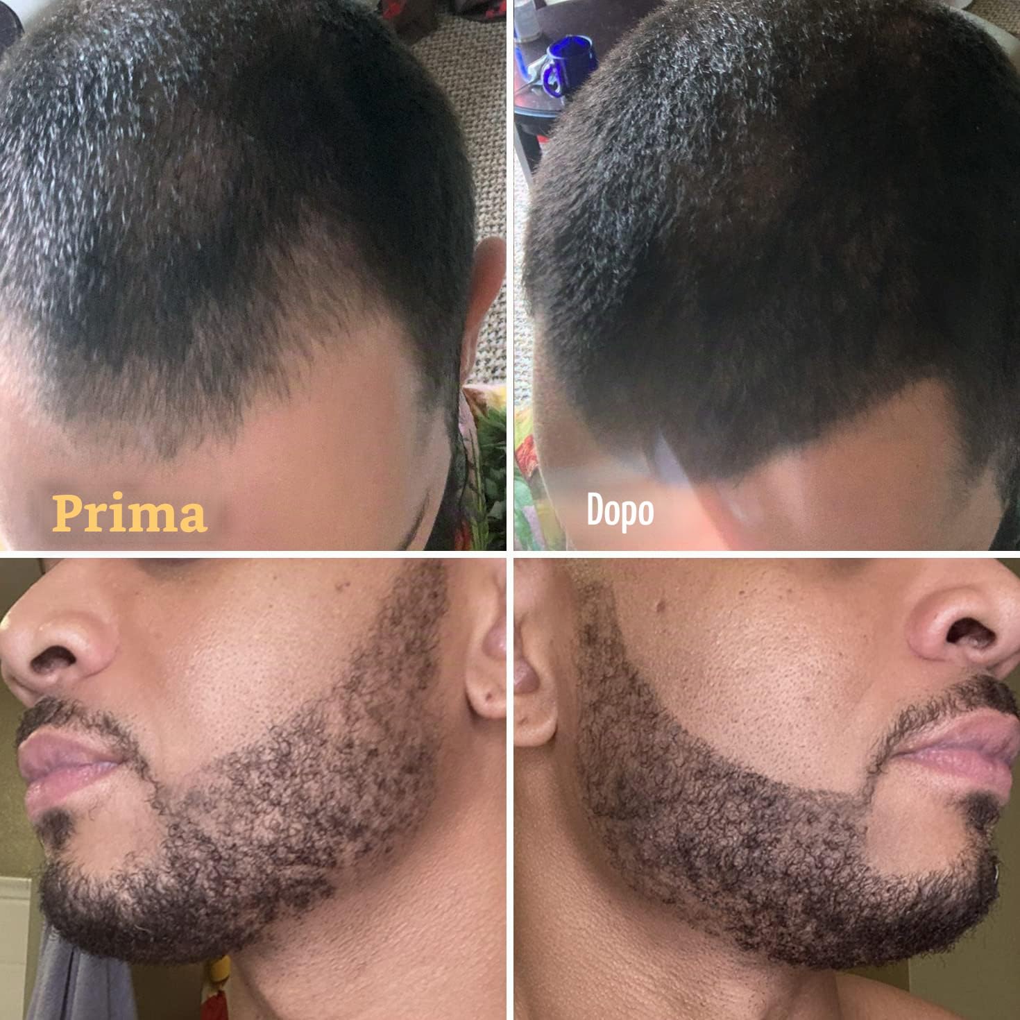 FOLLICLE BOOSTER Kit di riempimento per barba da uomo, nero, set completo per barba e cuoio capelluto con forcella brevettata a 4 punte e penna normale, impermeabile, a prova di sudore e tenuta tutto